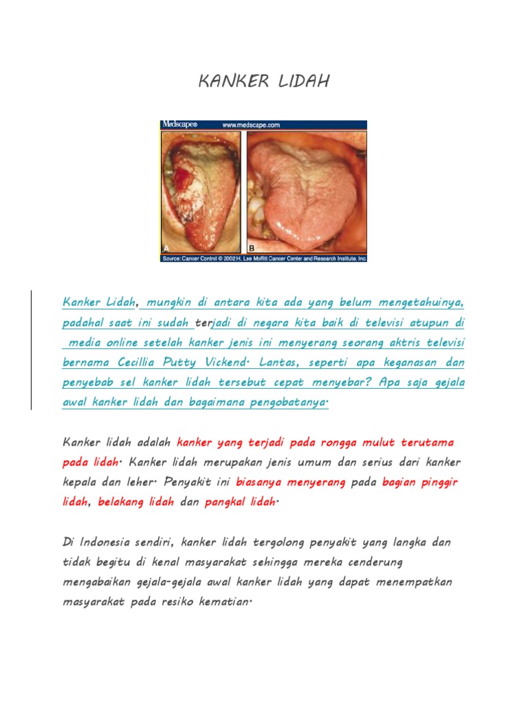 KANKER LIDAH.docx