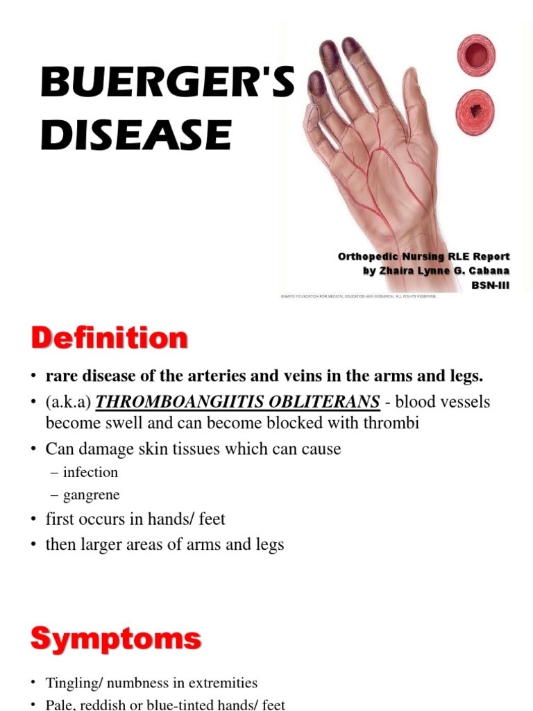 Buerger'S Disease Orthopedic Nursing RLE Report by Zhaira Lynne G