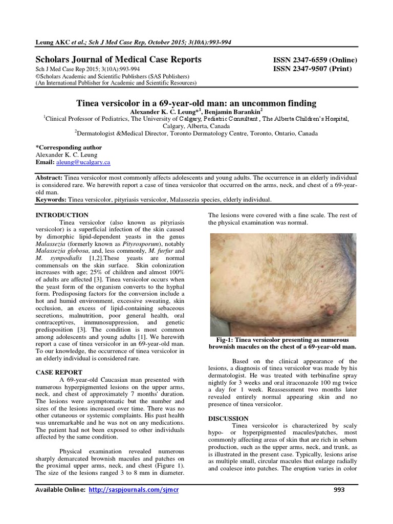 Tinea Versicolor PDF PDF Patient Dermatology