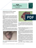 Angioqueratoma de Fordyce