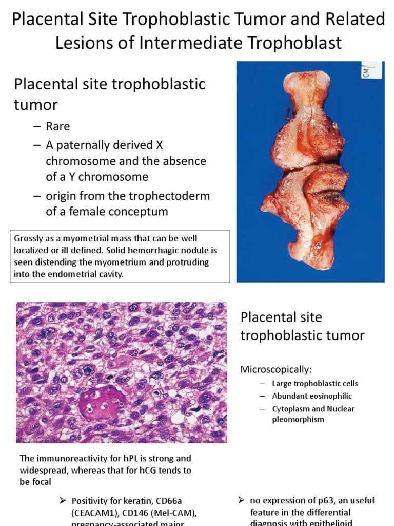 Placental Site Trophoblastic Tumor and Related Lesions of | PDF