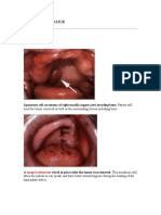 Surgical Obturator: Squamous Cell Carcinoma of Right Maxilla (Upper Jaw) Invading Bone. Patient Will