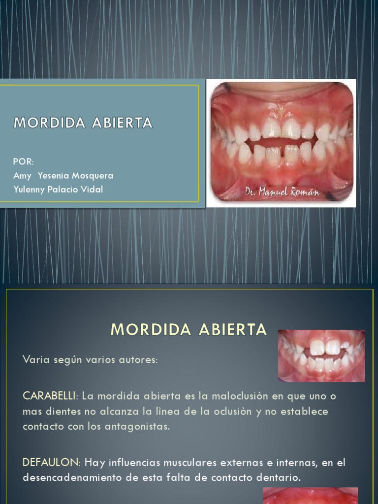 Tipos y características de mordida abierta | PDF | Diente | Boca