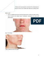 Blue Light vs ALA-PDT for Acne