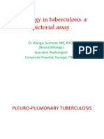 Radiology in Tuberculosis: A Pictorial Assay