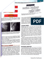 Myocardial Infarction Lewis 1 PDF