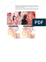 Avc Isquêmico