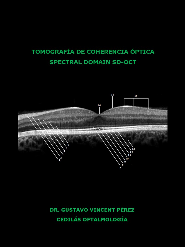Curso de OCT-Spectral Domain | PDF | Percepción visual | Diabetes mellitus
