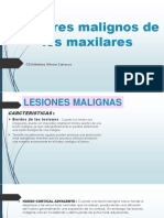 Tumores Malignos de Los Maxilares