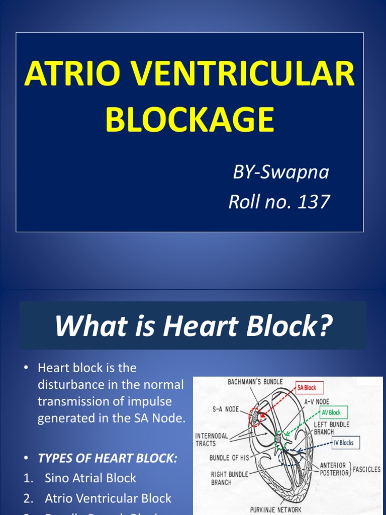 Atrio Ventricular Blockage Final PDF Atrium (Heart) Heart