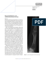 JHS (E) : Bony Myoepithelioma: A Rare Condition Presenting in The Hand