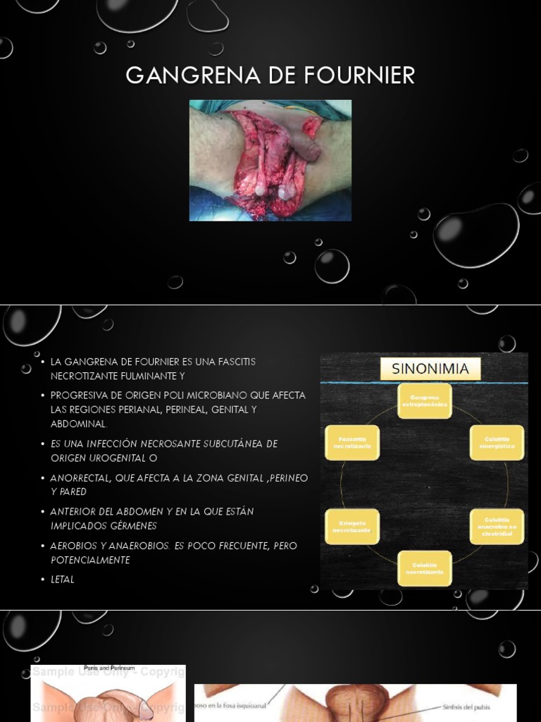 Gangrena de Fournier PDF Especialidades Medicas Enfermedades y trastornos