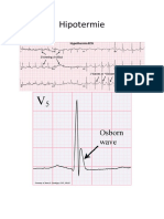 Hipotermie ECG