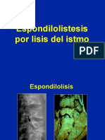 Espondilolistesis