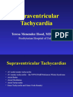 Supraventricular Tachycardia Causes, Symptoms and Treatment