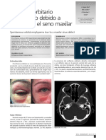 Enfisema Orbitario