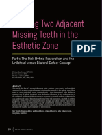 Treating Two Adjacent Missing Teeth in The Esthetic Zone