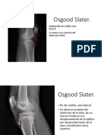 Fractura de tubérculo tibial