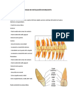 Técnicas de Instalación de Brackets