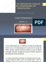 Resesion Gingival Periodoncia