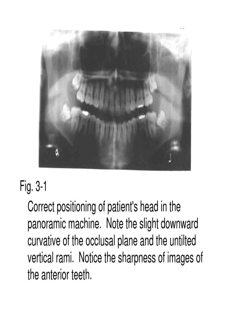 Chapter 03 Positioning Errors in Panoramic Radiography PDF PDF Anatomical Terms Of Location