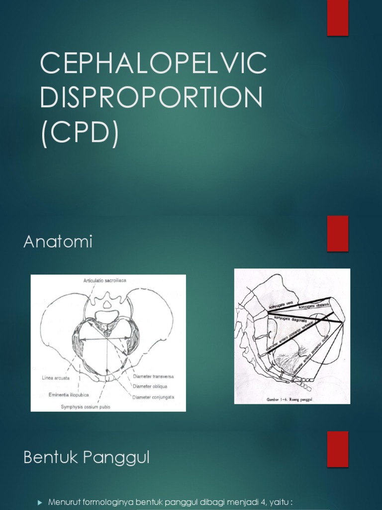 Cephalopelvic Disproportion (CPD) | PDF | Sains & Matematika