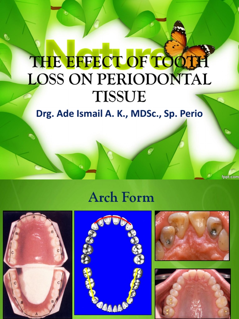 Impact of Tooth Loss on Periodontal Health | PDF | Mouth | Dentistry