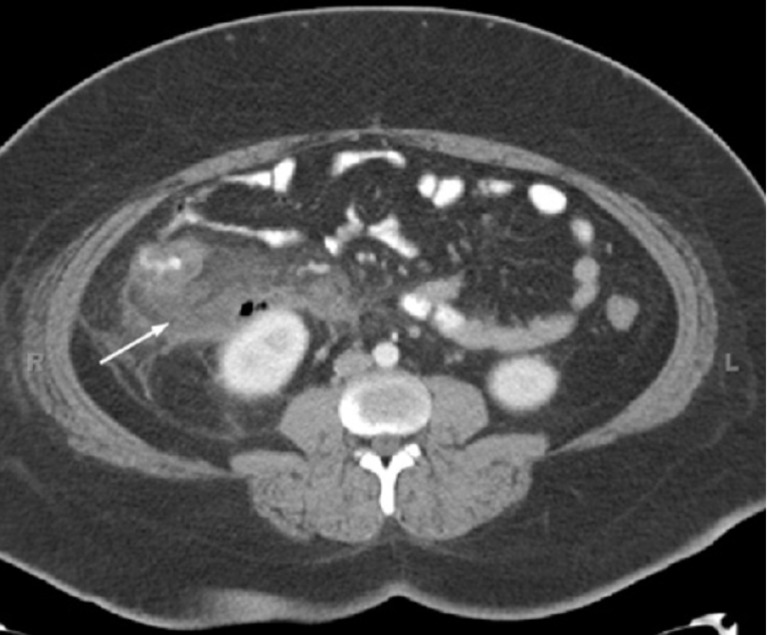 CT Scan_Abdominal Pain Modulk