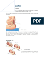 Tipos de Partos