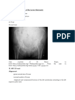 Acetabular Fracture