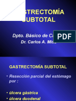 Gastrectomia Subtotal