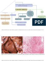 Inflamación Fibrinosa