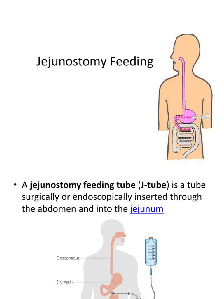 Jejunostomy Feeding PDF