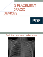 False Route Devices in Thoracal