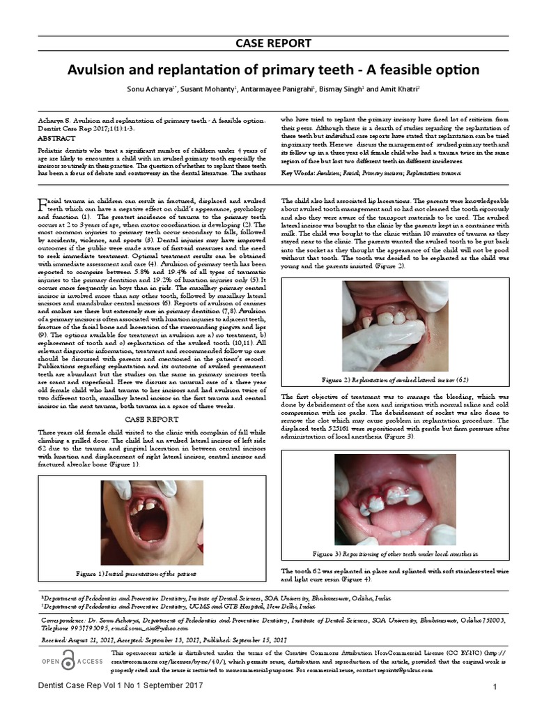 Replantation of Avulsed Primary Teeth | PDF | Human Tooth | Tooth