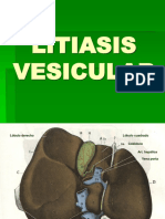 Litiasis Vesicular