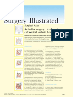 Antireflux Surgery Lich-Gregoir