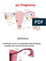 Ectopic Pregnancy