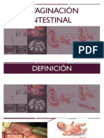 Invaginación Intestinal