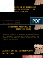 Disminución de DVO