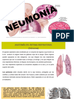 Neumonia