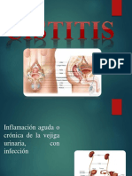 Cistitis