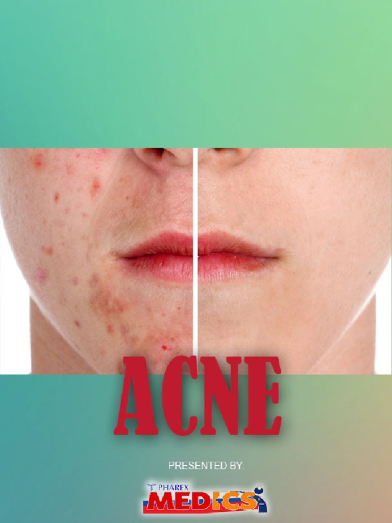 whats the purpose of acne