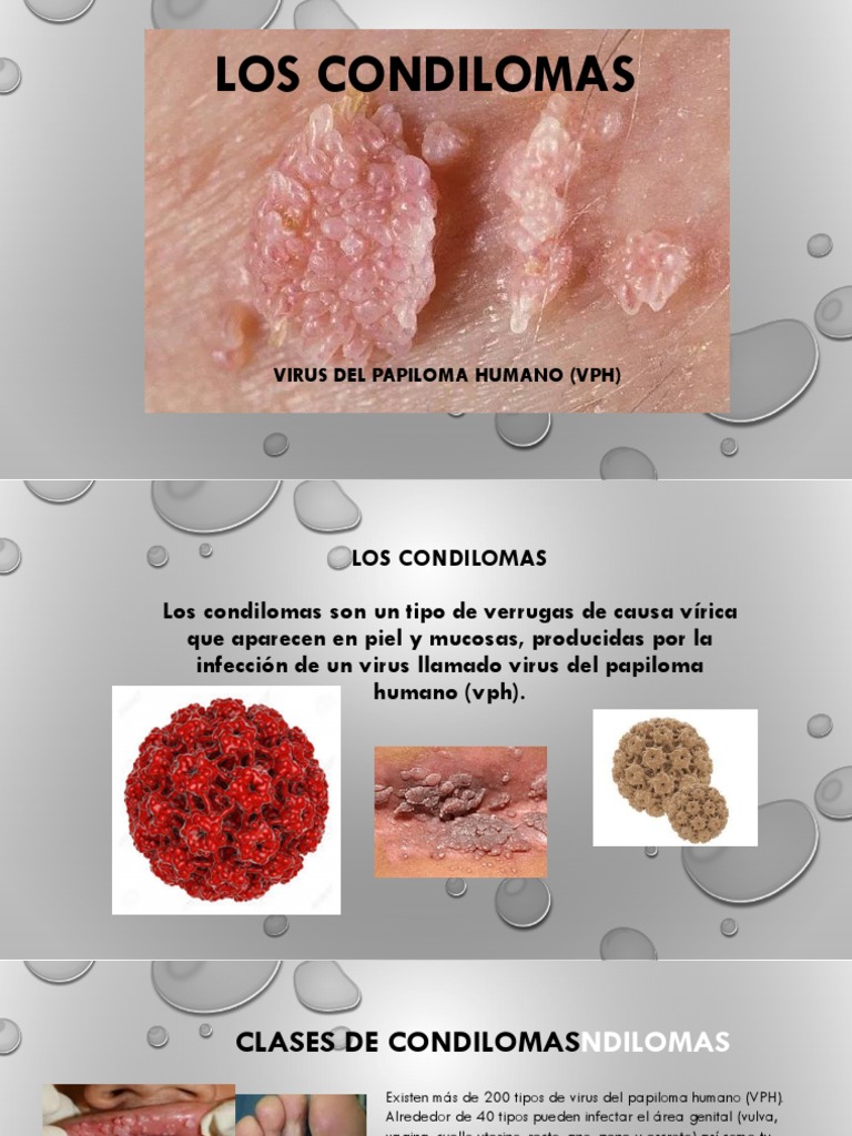 Tipos y Tratamientos de Condilomas | PDF | Especialidades Medicas ...