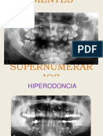 dientes supernumerarios