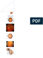 Retinal Detachment