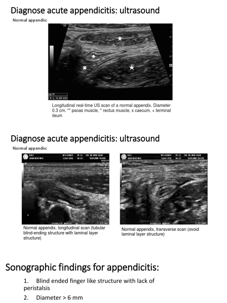 Ultrasound Diagnosis of Appendicitis | PDF | Medical Ultrasound ...
