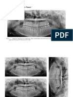 Keratocystic Odontogenic Tumorpo1