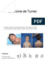 Sindrome de Turner