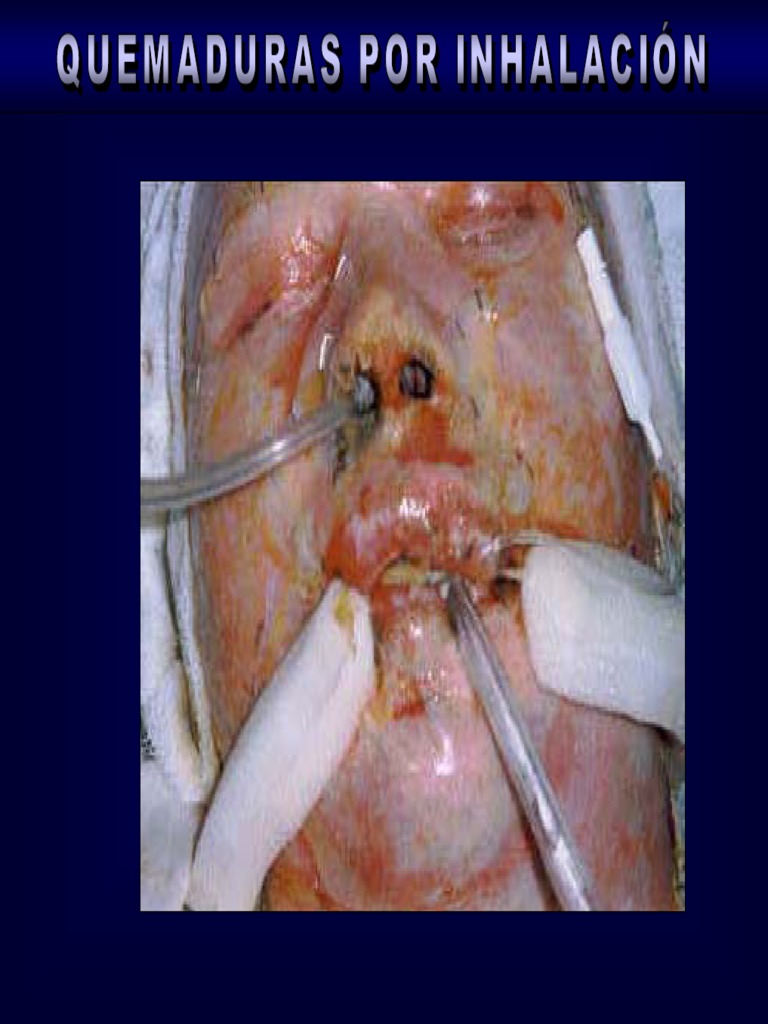 Quemaduras Por Inhalación PDF | PDF | Quemar | Tos
